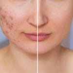 Acne Scar Treatment