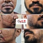 Beard Transplant