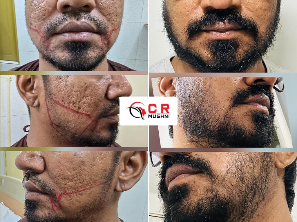 Beard Transplant
