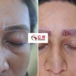 Eyebrow Transplant