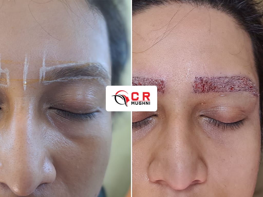 Eyebrow Transplant