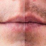 Mustache Transplant