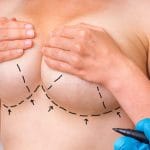 Breast Reduction