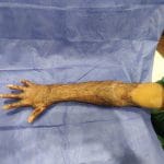 Burn Contracture