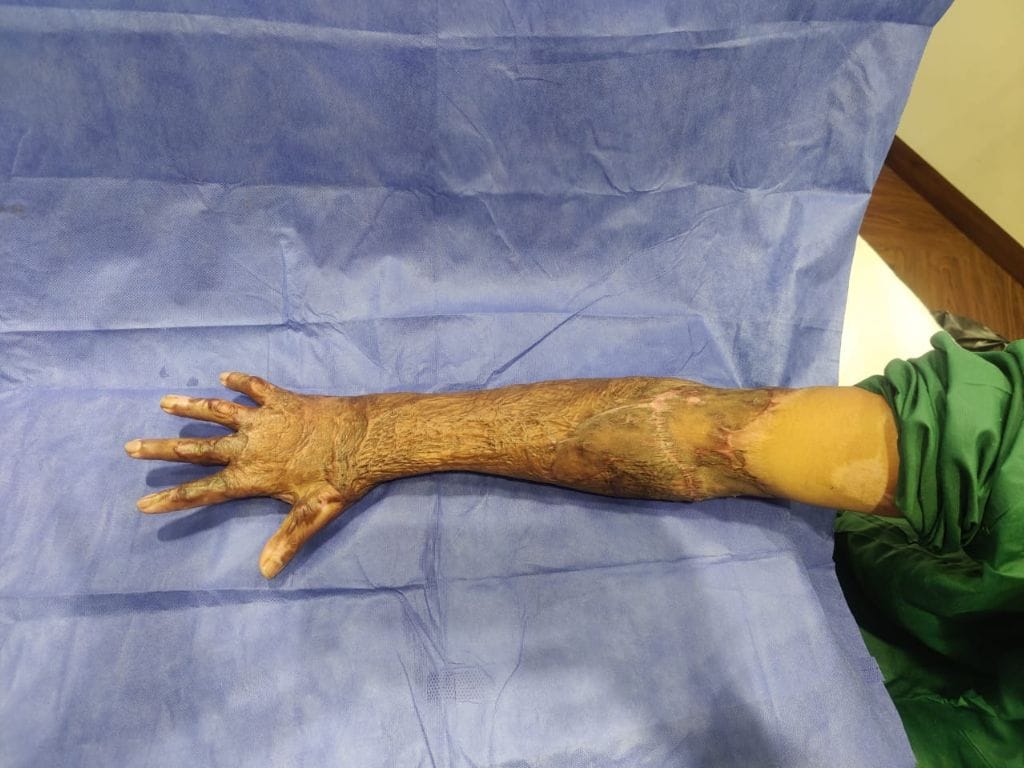 Burn Contracture