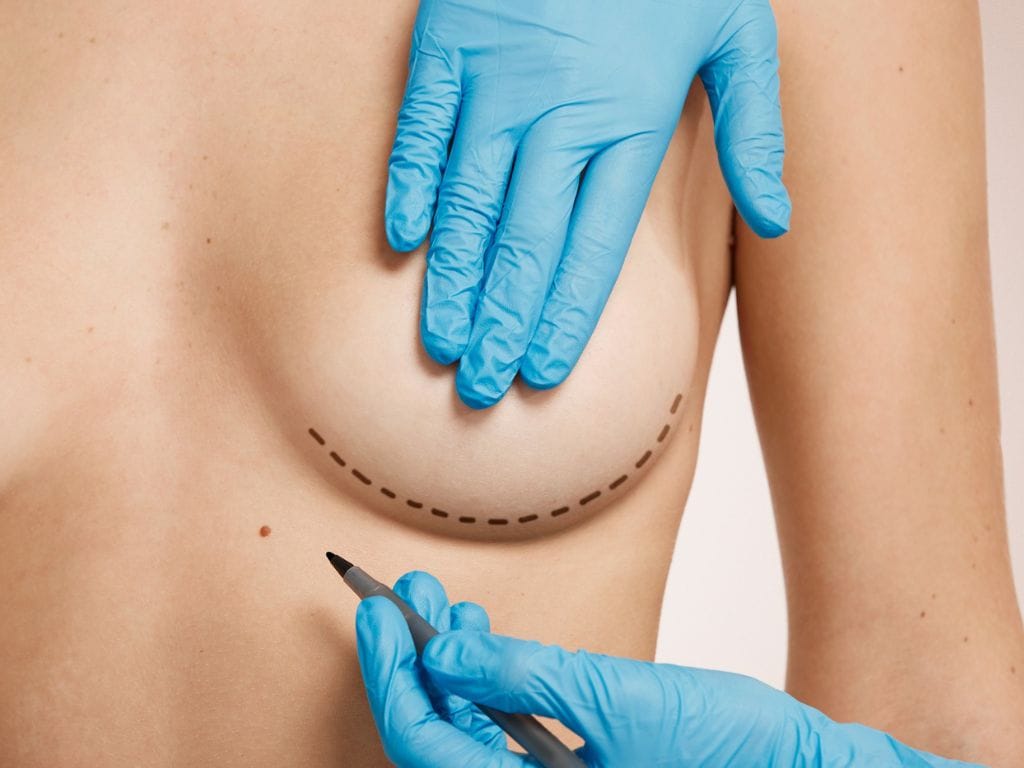 Mastopexy (Breast Lift)